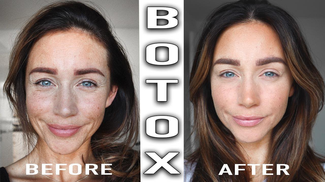Botox: A Safe and Effective Treatment for Fine Lines and Wrinkles